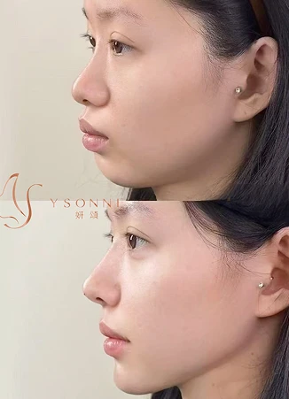 超導水合療法治療缺水和暗沉皮膚