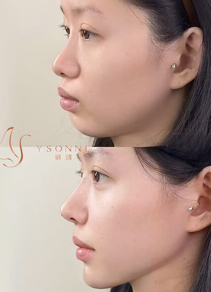  超導水合療法治療缺水和暗沉皮膚